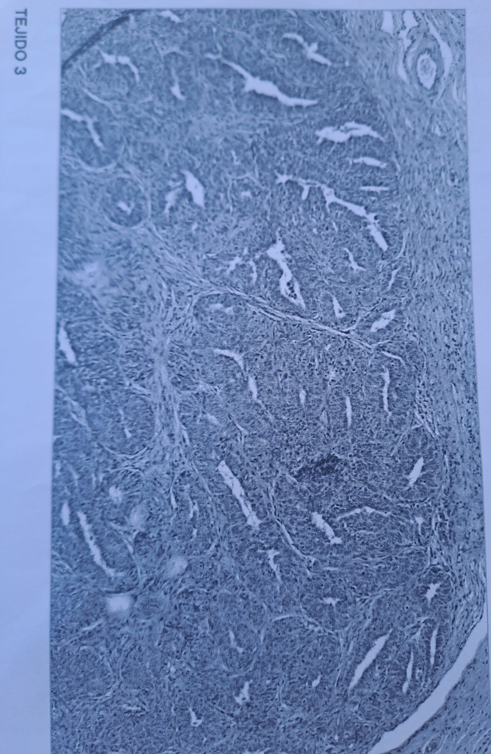 imágenes de biopsia de tumor mamario carcinoma en ginebra canespasion